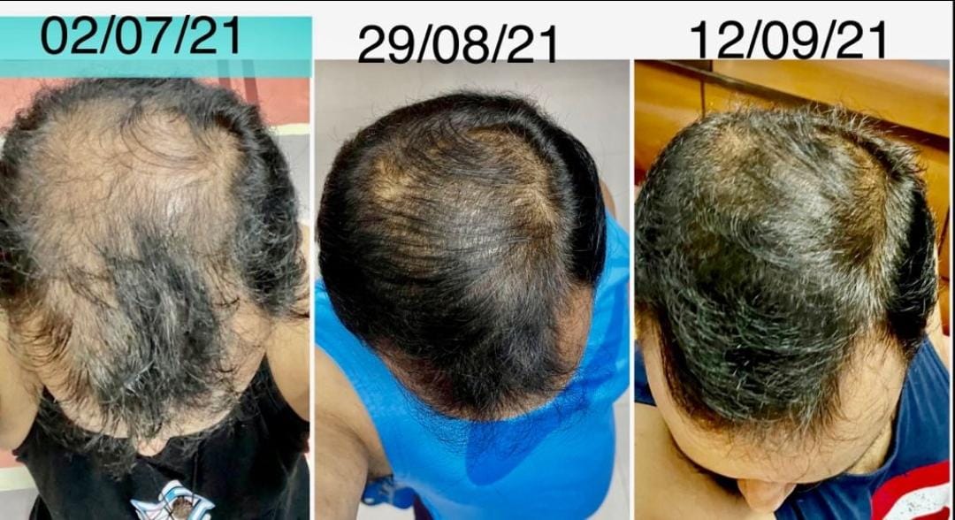 Hair Transplant Clinic in Jodhpur