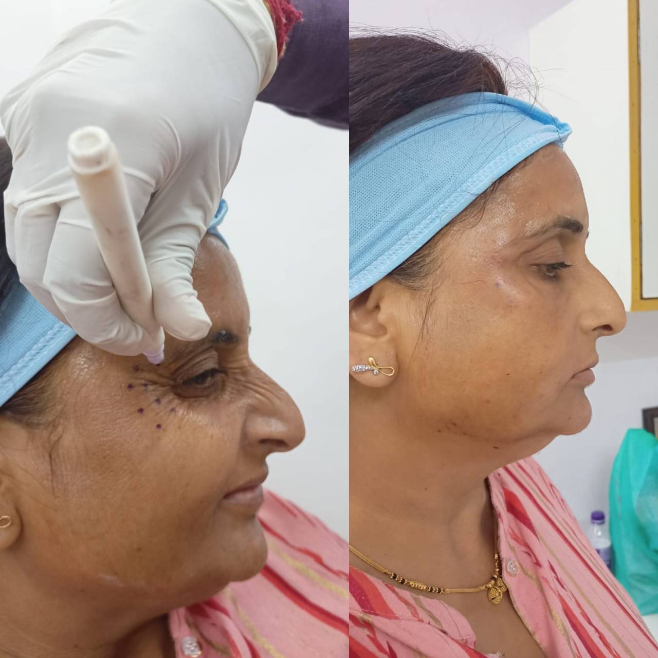 Best Anti Aging Treatment in Udaipur