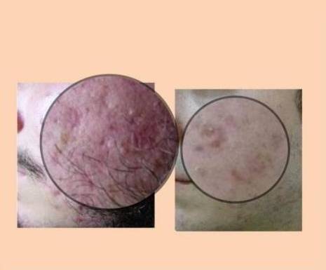 Acne Scar Treatment in Udaipur