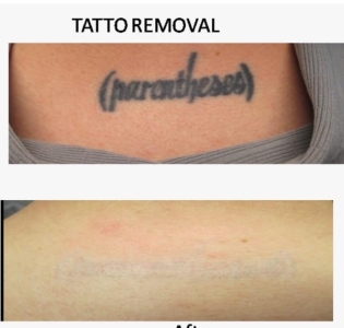 Tattoo Removal in Udaipur