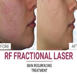 Laser Skin Treatment in Udaipur