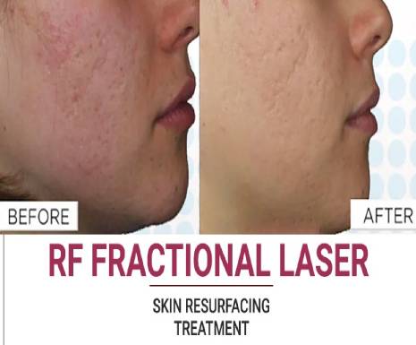 Laser Skin Treatment in Udaipur