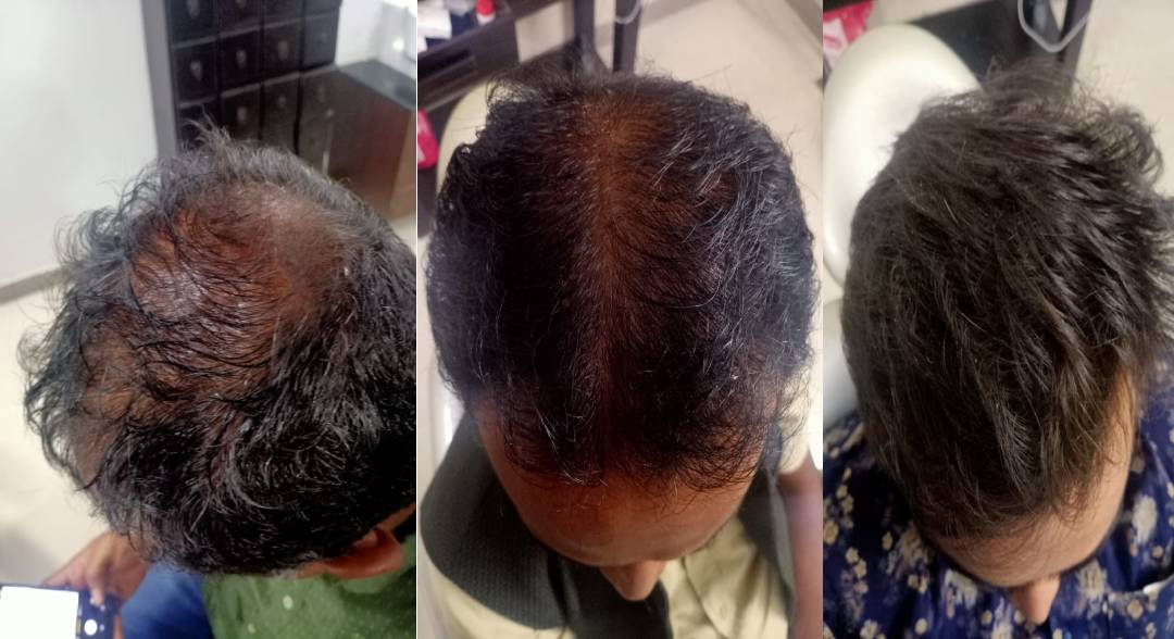 Hair Transplant Clinic in Udaipur